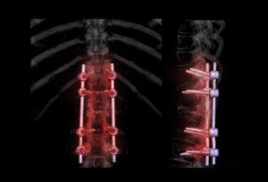 lumbar spine AP and Lateral view for diagnosis spinal canal stenosis and degenerative disc disease showing pedicle screw implant after surgical decompression and spinal fusion.