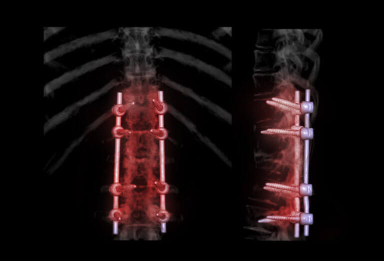 lumbar spine AP and Lateral view for diagnosis spinal canal stenosis and degenerative disc disease showing pedicle screw implant after surgical decompression and spinal fusion.