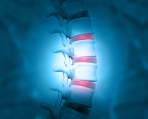 Image of a human spine with disc problems