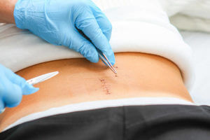 Patient after spinal disc operation...nurse removing stitches