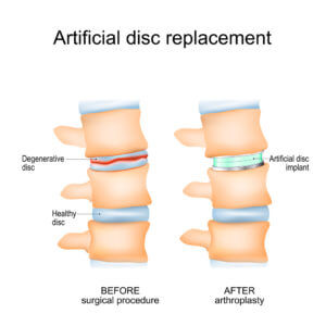 Artificial Disc Replacement