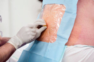 Anesthesiologist hands giving spinal injection to a patient. Spinal needle being placed through the introducer needle for epidural nerve block.