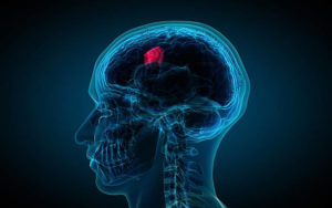 x-ray of brain showing tumor. Computer generated images with correct male anatomy, showing brain with a glowing tumor inside.