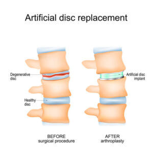 Degenerative Disc and Artificial disc replacement.