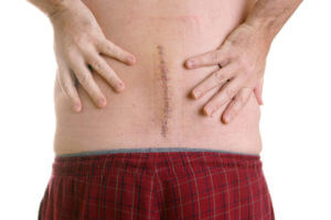 Patient Showing His scars after Spine Surgery