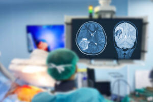 Brain Tumors Surgical Approaches