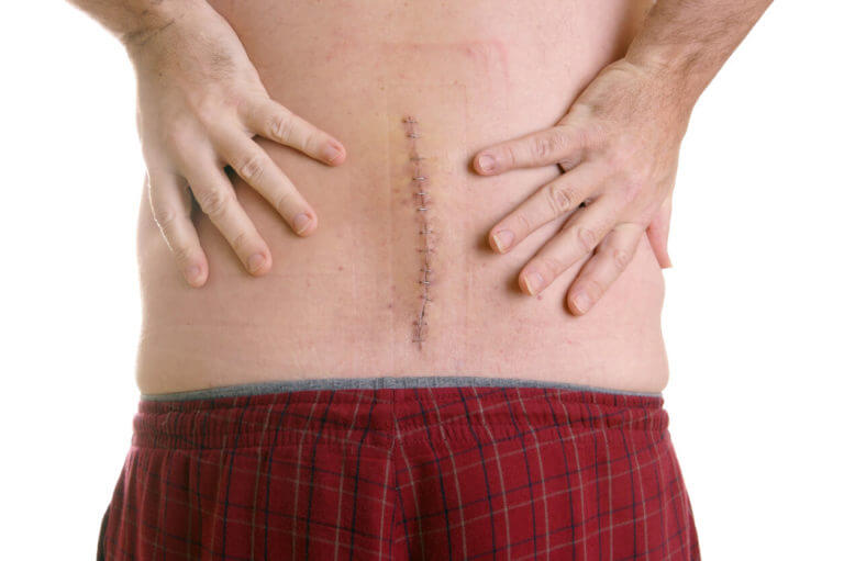 Patient after spine surgery