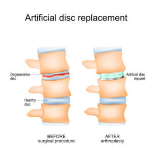 Artificial Disc Replacement illustration