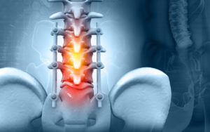 X-ray of a person with a spinal column with an implant as a result of minimally invasive spinal surgery for spinal fractures.