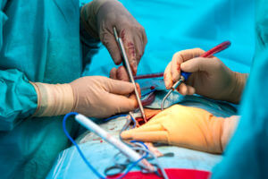 The hands of an orthopedic surgeon performing spinal surgery on the human spine.
