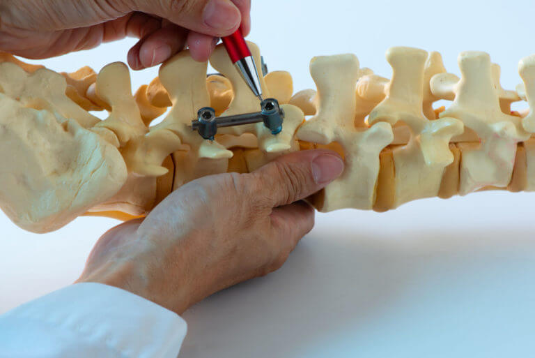 A spine doctor demonstrating instrument fixation for the lumbar spine, a concept of minimally invasive spinal surgery.