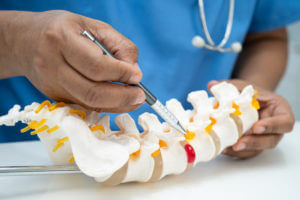 A doctor holding a model of the spinal nerve and bone, illustrating a displaced herniated disc fragment for minimally invasive spinal surgery.