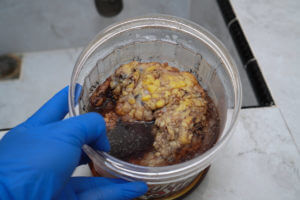 A doctor's blue-gloved hand holds a container with a tumor tissue sample for histological examination.