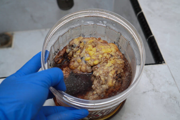 A doctor's blue-gloved hand holds a container with a tumor tissue sample for histological examination.