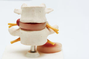 A model of the lumbar spine and herniated disc is on the table to explain artificial discs.