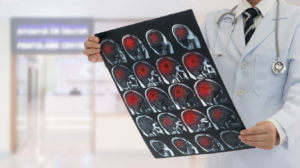 A neurologist holding a brain stroke scan.