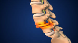 An Image of Spondylolisthesis Involving Vertebrae Shifting Out of Place.