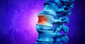 Image of spinal compression fracture.