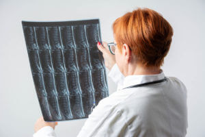 Rear view of a female spine doctor reviewing a patient’s X-ray related to a spinal cord injury.